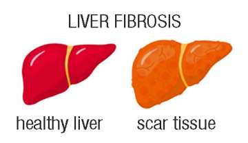 Liver Fibrosis: Picture comparison of healthy liver vs. liver with scar tissue