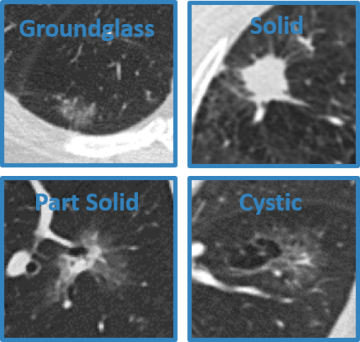 Lung Nodules Scanned