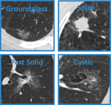 Lung Nodules Scanned