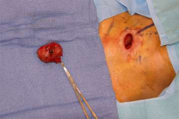 2.5 cm (7810 mg) parathyroid adenoma removed through a 2 cm incision.