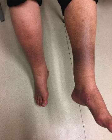 Patient's legs swollen due to IVC occlusion