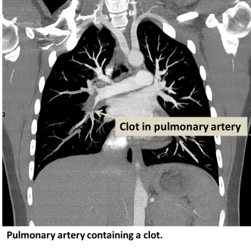 Pulmonary artery containing a clot