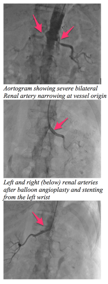 peripheral renal stenting