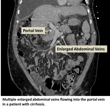 Multiple enlarged abdominal veins flowing into the portal vein in a patient with cirrhosis.