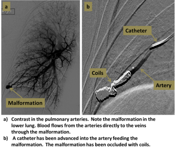 Two step diagram of pulmonary angiography process