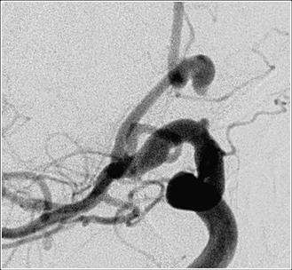 Figure 3. Before Treatment: Hemorrhagic stroke from ruptured intracranial aneurysm.