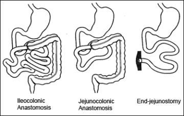 Depictions of short bowel