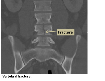 Vertebral fracture