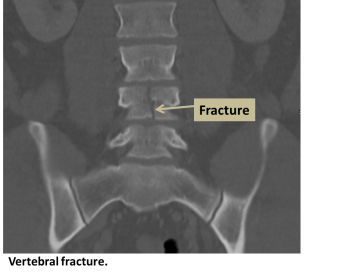 Vertebral fracture