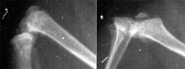 xray showcasing osteoarthritis