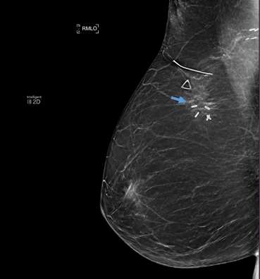 Case: Fat Necrosis of Breast Figure 2