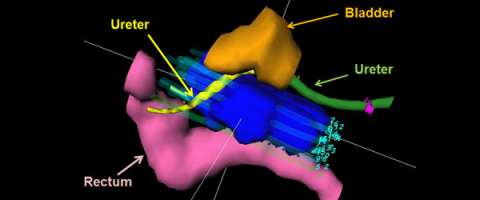 gynecologic interstitial implant: