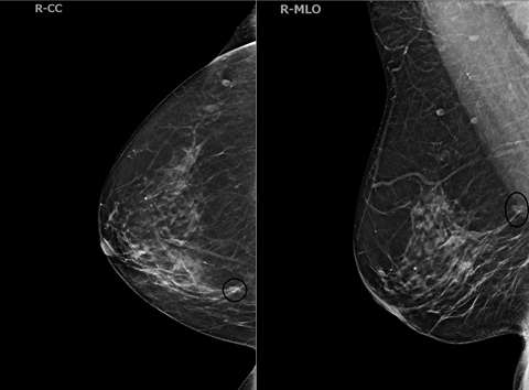 Case: Invasive Lobular Carcinoma Figure 4