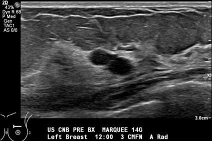Procedure: US Guided Cyst Aspiration Figure 1
