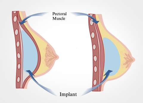 Breast MRI Findings: Breast Implant - Radiology