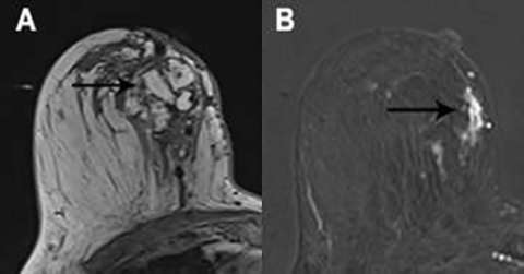 Breast MRI Findings: Post-surgical Findings Fat Necrosis