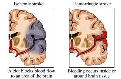 Acute Stroke Figure 1