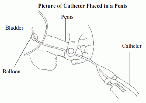 catheter