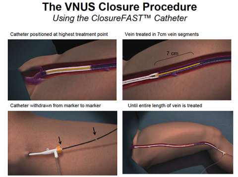 The VNUS Closure Procedure