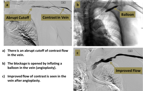 Three step diagram of dialysis fistula graft process