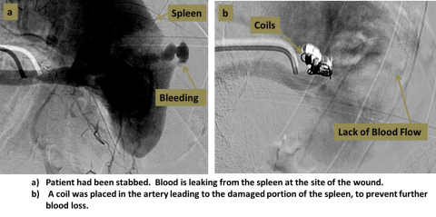Two step diagram of embolization process. A. Showing a spleen and bleeding. B. Showing the placing of a coil in the artery leading to the damaged portion of the spleen, to prevent further blood loss.