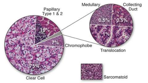 Sub-Types of Renal Cell Carcinoma (RCC)