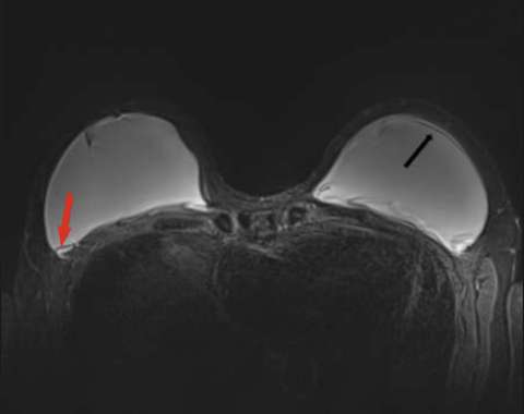 Figure 6: Sagittal T2-weighted image shows teardrop sign of intracapsular rupture.