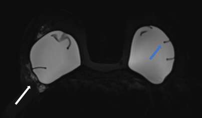 Figure 5: Silicone-sensitive image shows hyperintense extracapsular silicone (white arrow) and keyhole sign (blue arrow).