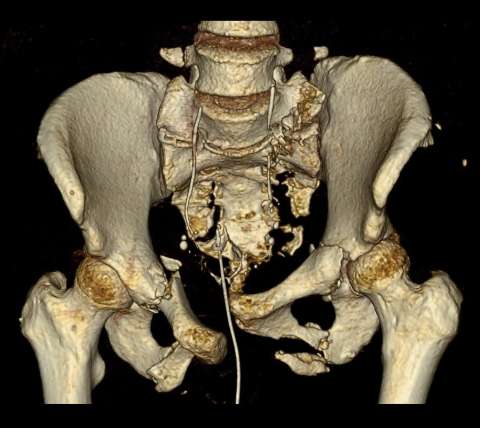 Pelvic Fractures