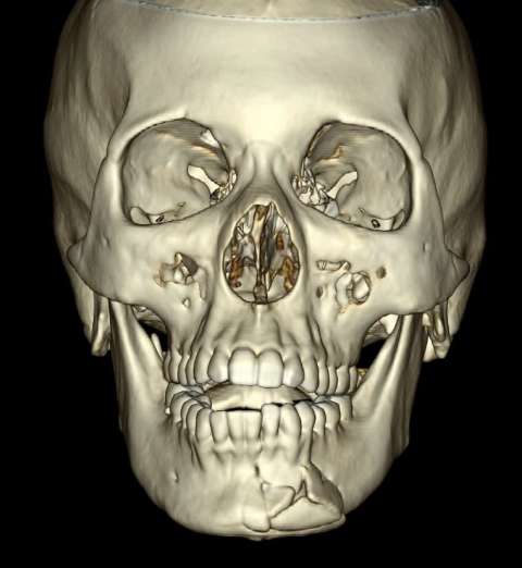 Mandibular Fractures