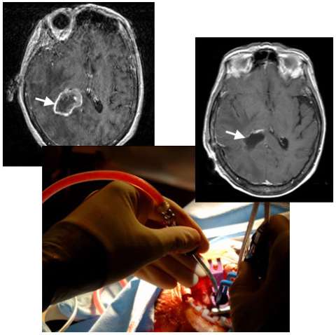 Metatastic Brain Tumor