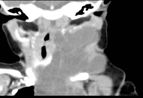Coronal CT with contrast demonstrating large left neck macrocystic lymphatic malformation