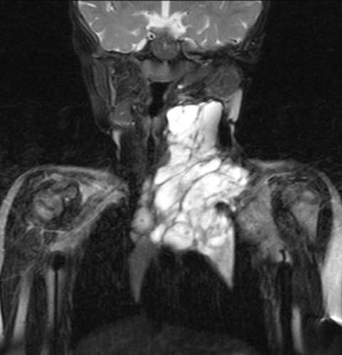 Coronal MRI STIR images demonstrating large left neck macrocystic lymphatic malformation