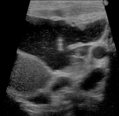 US guided needle placement into a macrocystic lymphatic malformation