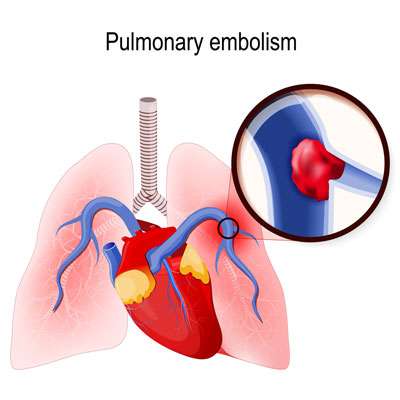 Pulmonary Embolism diagram