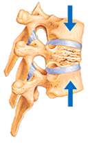 Spinal Compression Fractures - Neurosurgery | UCLA Health