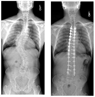 Male with untreated adolescent scoliosis, treated with T4 to L4 fusion