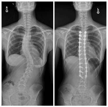 Female with adolescent idiopathic scoliosis, treated with T4 to L3 posterior fusion