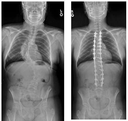 Young female with adolescent idiopathic scoliosis, treated with T4 to L4 posterior fusion