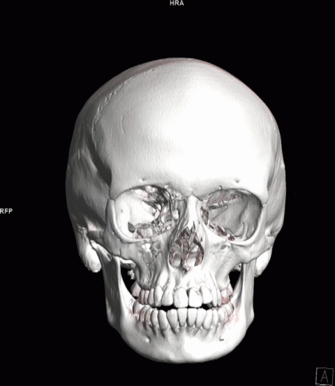 3D Skull Rotation