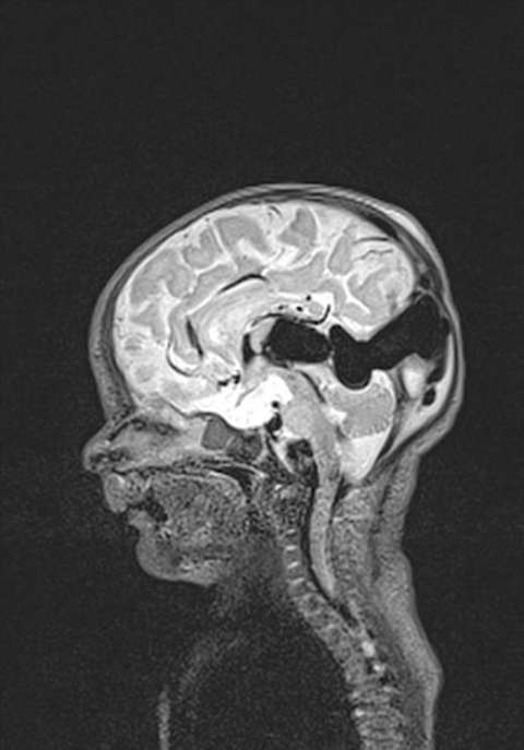 VGM1 - MRI Brain