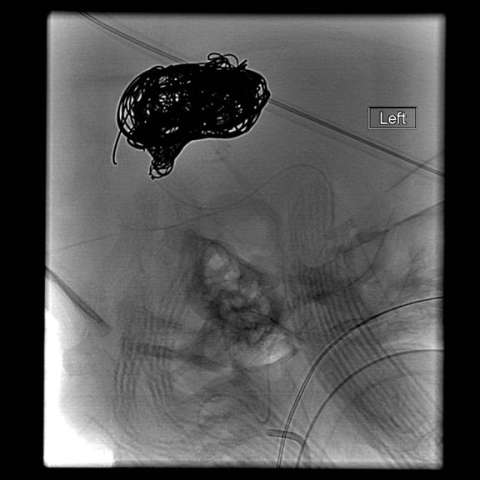 Endovascular embolization with coils 