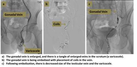 Varicocele Embolization diagram in three steps