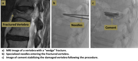 Three step diagram of vertebroplasty process