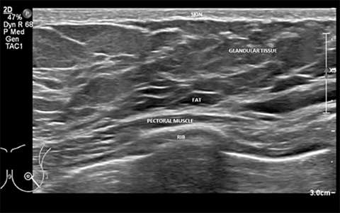 Basic of Breast Ultrasound Figure 4