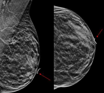 Case: Paget's Disease Figure 1