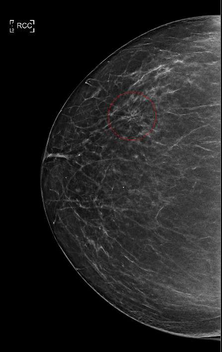 Craniocaudal mammogram view showing an architectural distortion within the lateral right breast (red circle). Note the irregular radiating lines from a central focal region compared to the surrounding normal breast parenchyma.