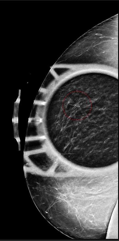 Additional spot compression views of the architectural distortion seen on craniocaudal mammogram view shows persistence of the architectural distortion within the lateral right breast (red circle). This appearance is consistent with a real distortion of the breast parenchyma and not simply overlapping normal fibroglandular tissue.