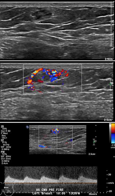 Arteriovenous malformation.