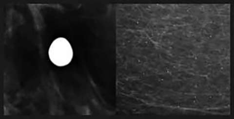 Round Calcifications